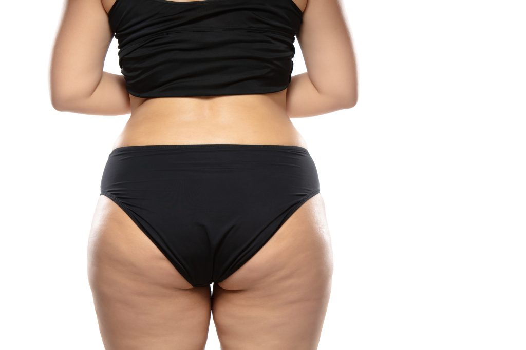 Desmitificando la Celulitis: Guía Completa para entender y tratar esta afección estética